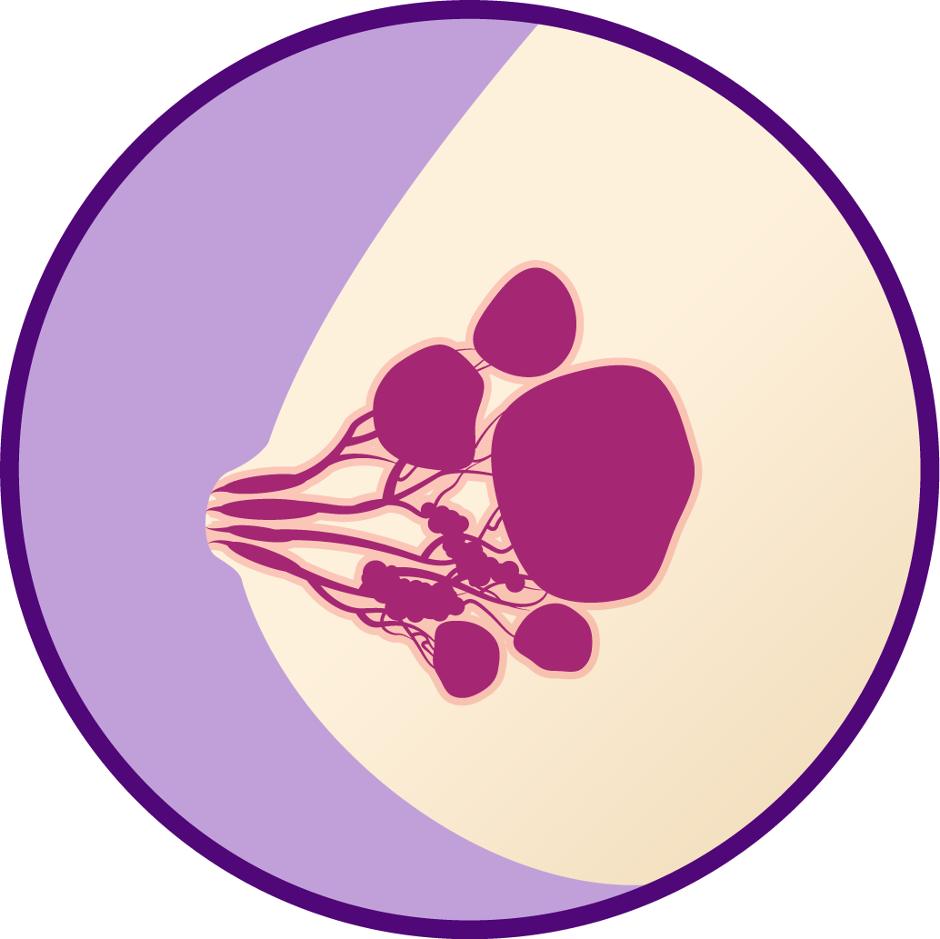 Fibrocystic breasts